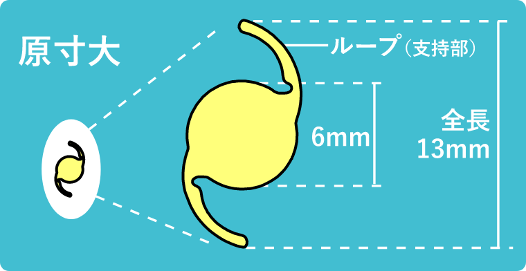 眼内レンズとは